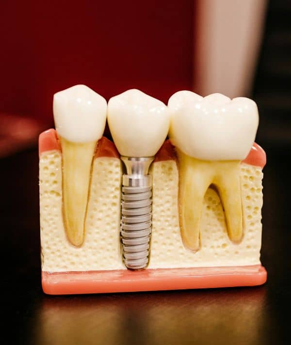 A model showing the real life root system of teeth and root canal therapies target