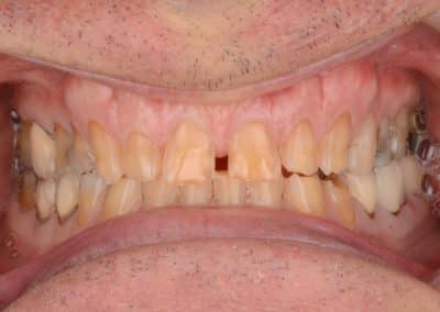 Teeth Whitening and Crown Before Photo