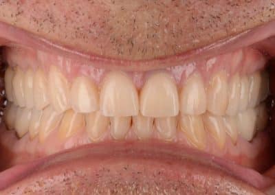 Teeth Whitening, Crown After Photo