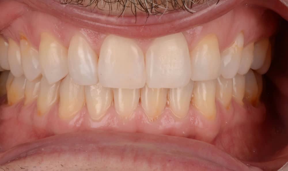 Veneers After