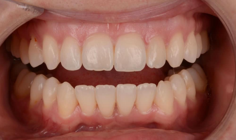 Veneers After