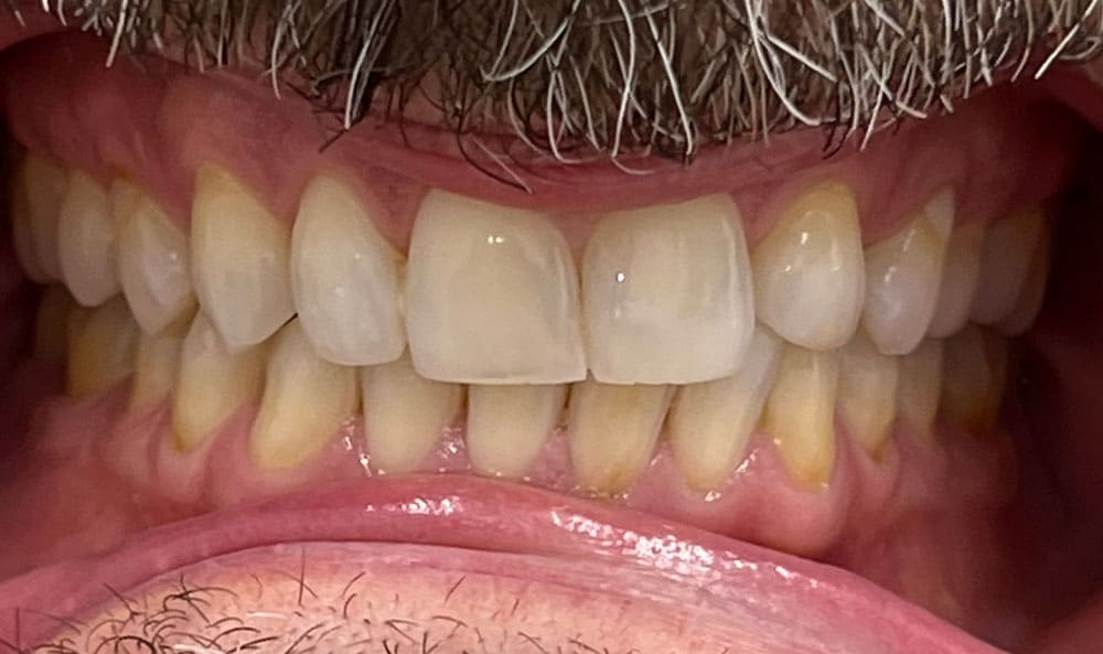 Veneers Before