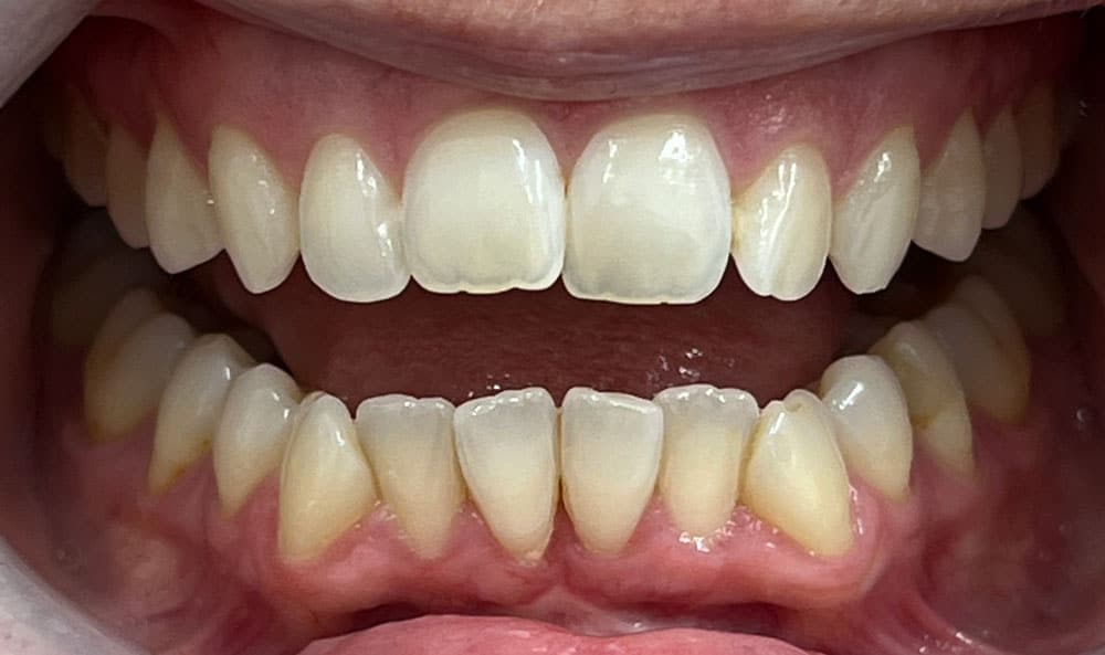 Veneers After