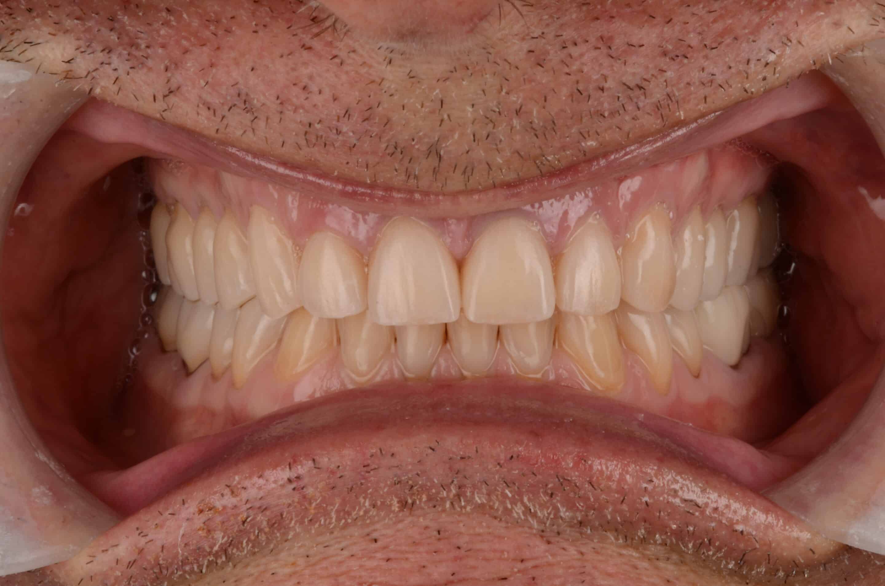 A dental patient after composite bonding