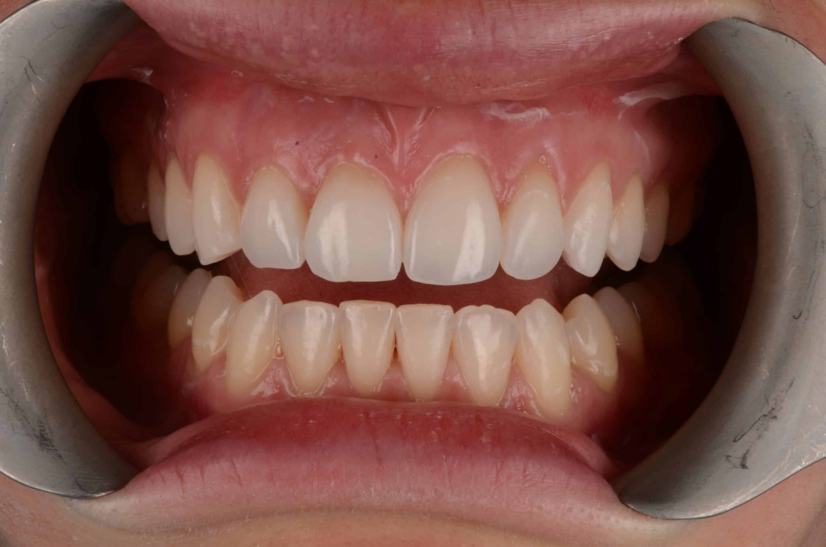 A young lady trying on Invisalign