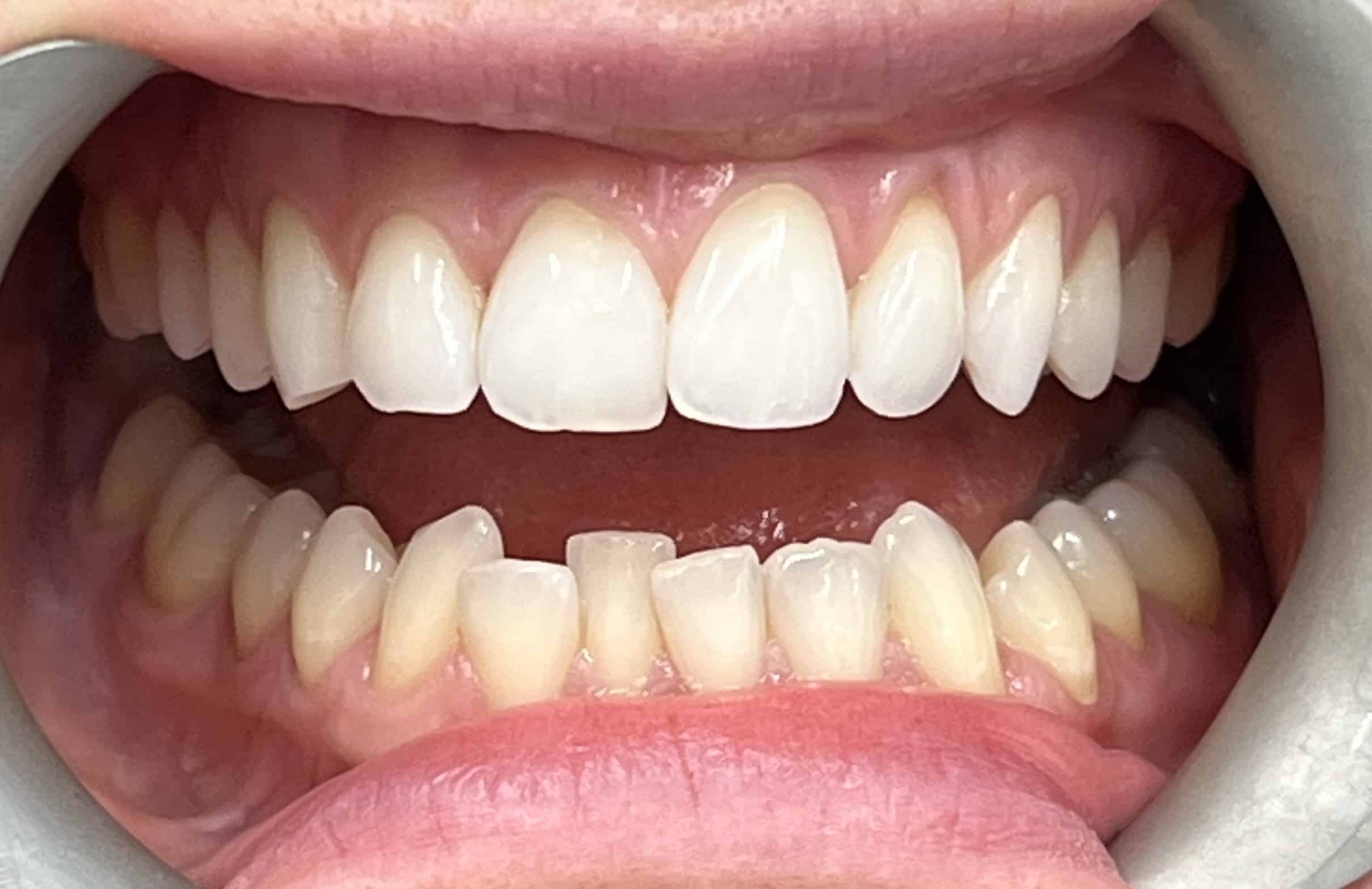 A young lady trying on Invisalign