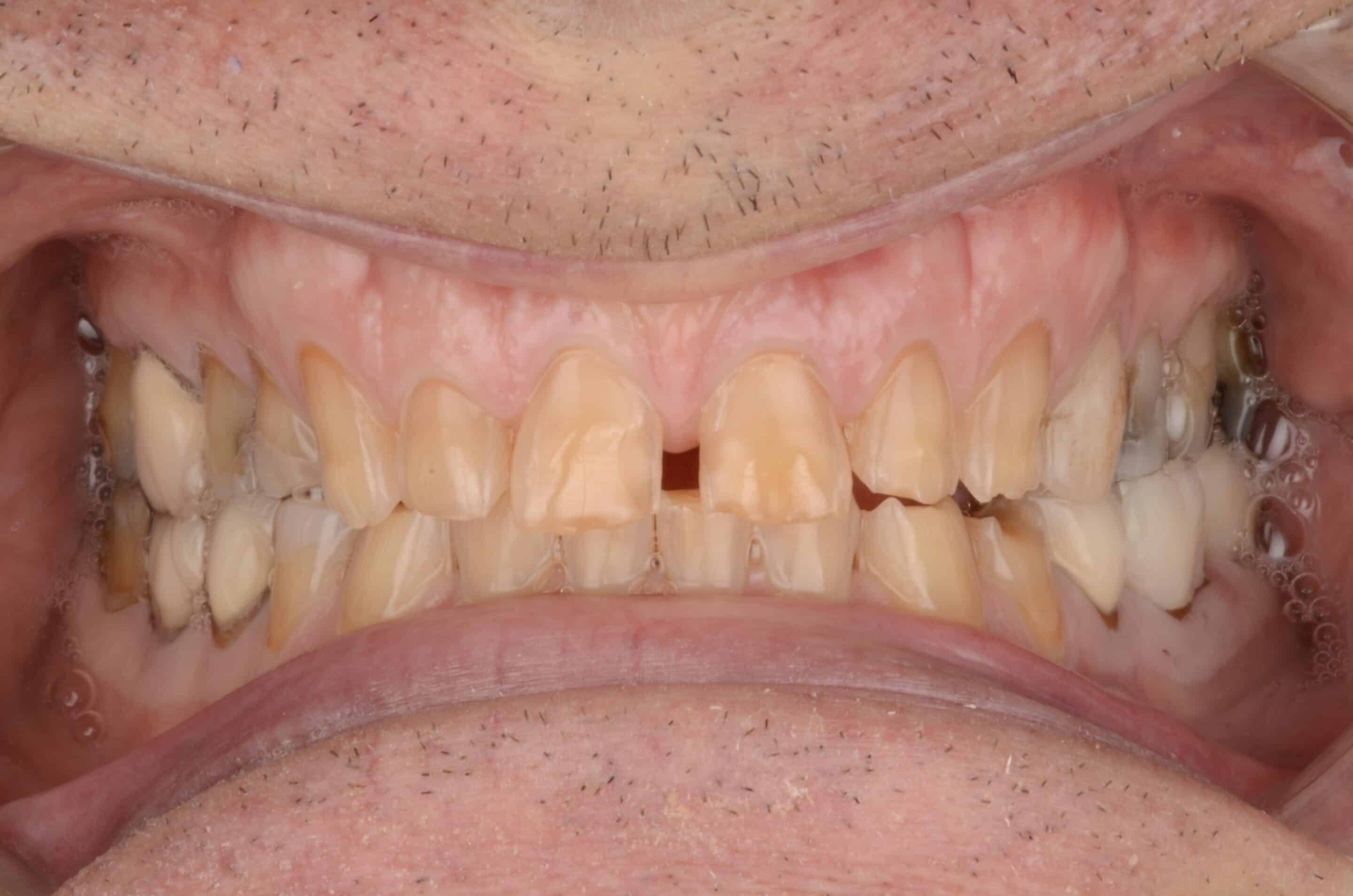 A dental patient after composite bonding